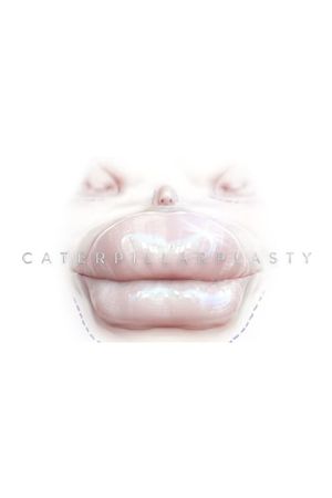 Caterpillarplasty's poster