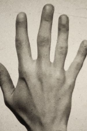 Fifth Metacarpal's poster