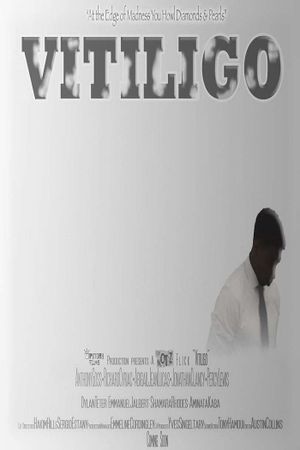 Vitiligo's poster