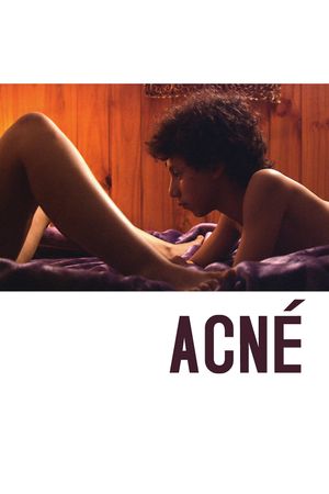 Acne's poster