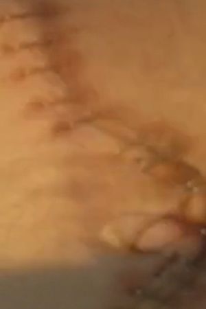Suite: Double Nephrectomy's poster