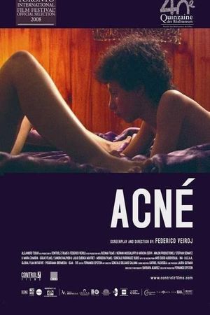 Acne's poster