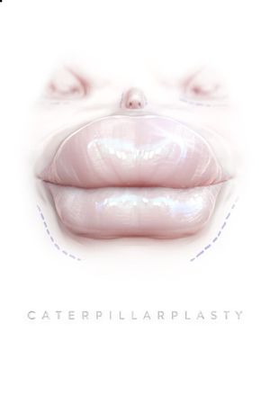 Caterpillarplasty's poster